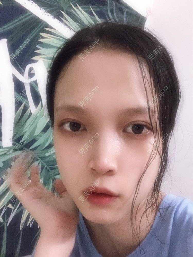 更美 - 更美用户NpS93HK67Y的双眼皮经验 | 双眼皮 | 广州