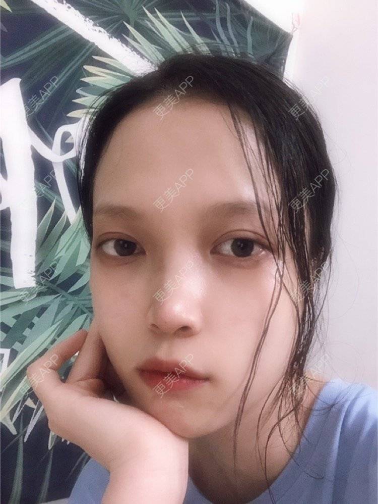更美 - 更美用户NpS93HK67Y的双眼皮经验 | 双眼皮 | 广州