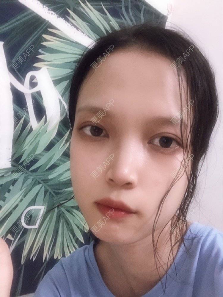 更美 - 更美用户NpS93HK67Y的双眼皮经验 | 双眼皮 | 广州