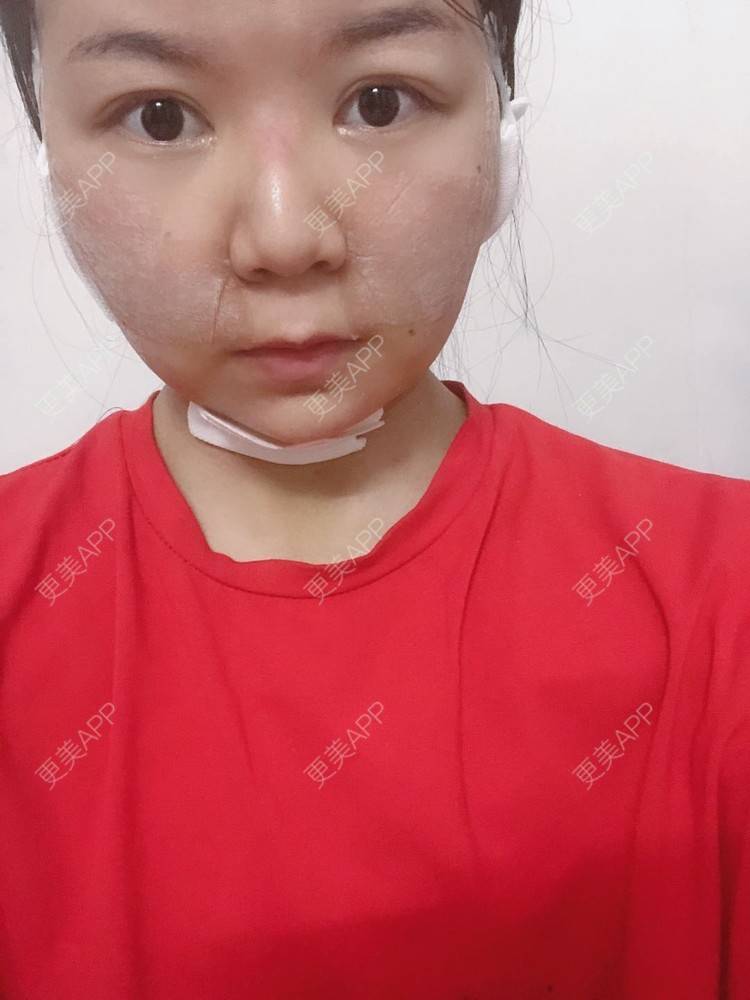 更美 - _对不起，滚远了荣的激光去脂肪粒经验 | 激光去脂肪粒 | 武汉