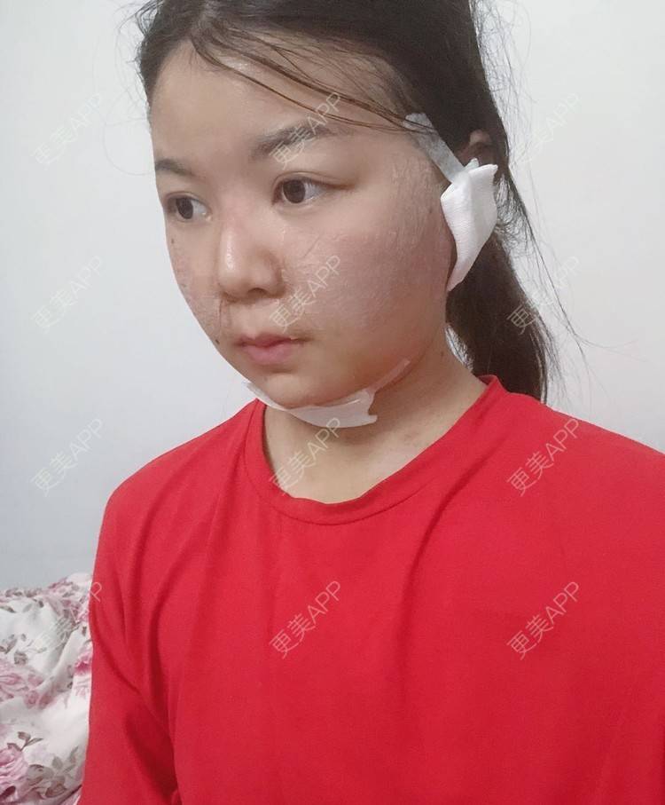 更美 - _对不起，滚远了荣的激光去脂肪粒经验 | 激光去脂肪粒 | 武汉