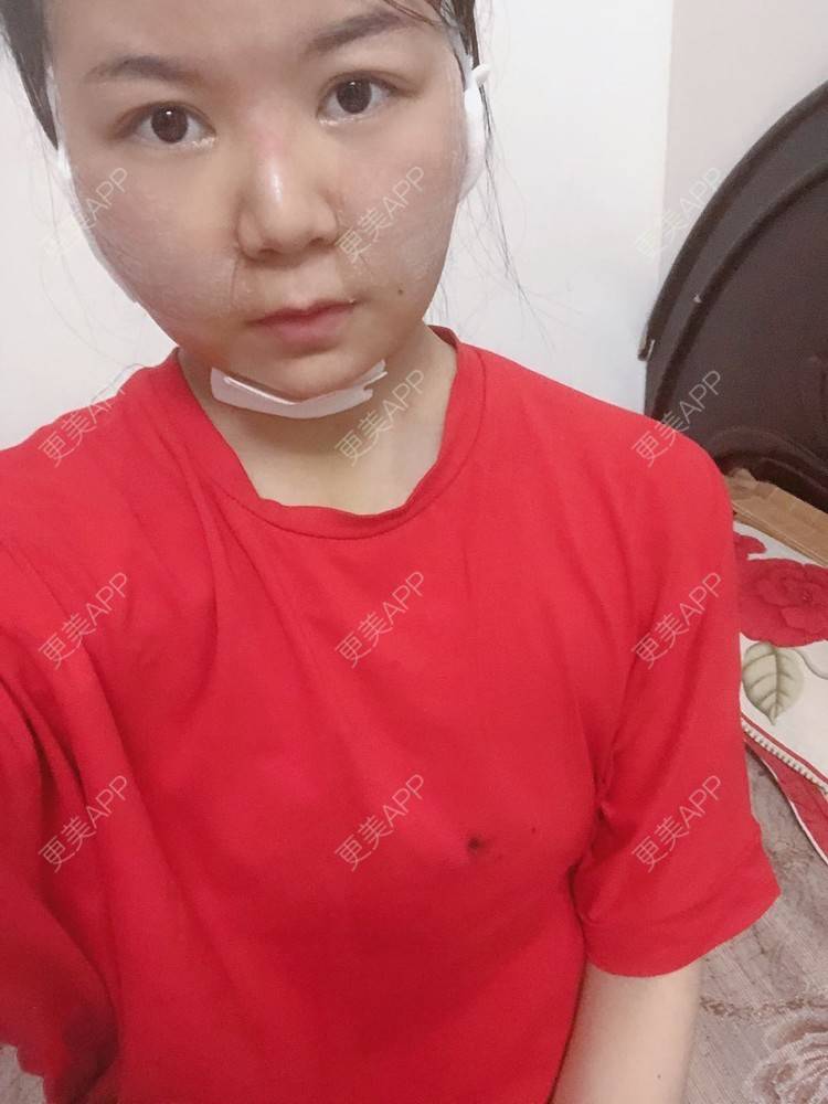 更美 - _对不起，滚远了荣的激光去脂肪粒经验 | 激光去脂肪粒 | 武汉