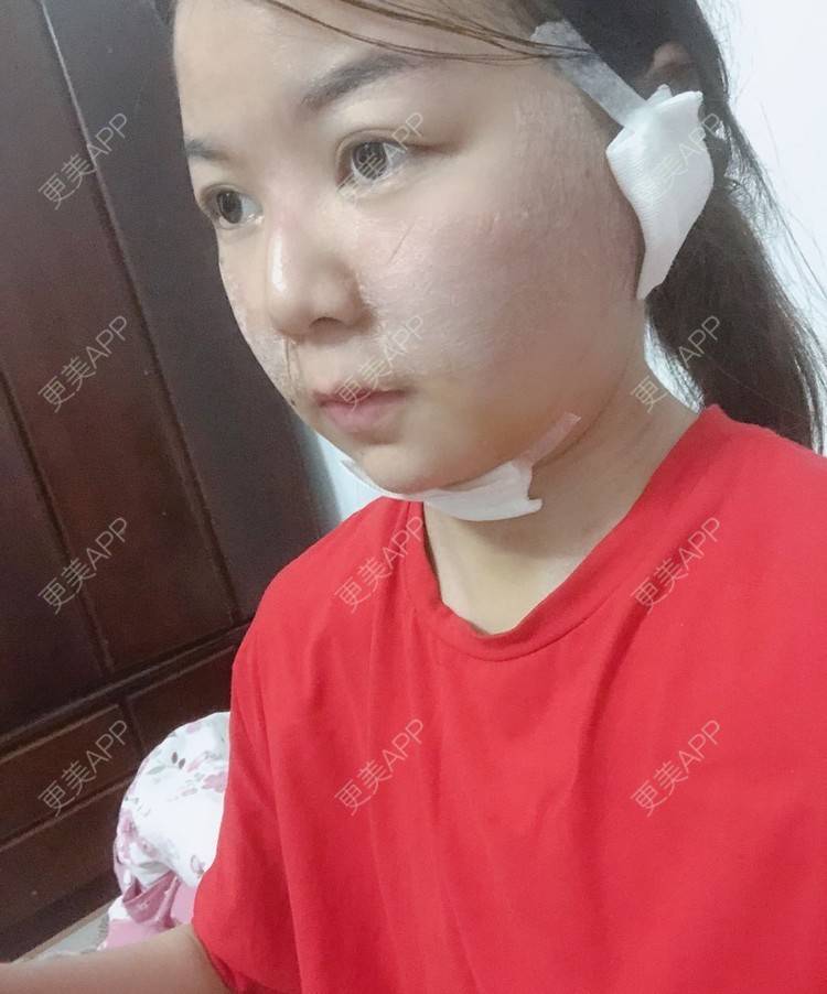 更美 - _对不起，滚远了荣的激光去脂肪粒经验 | 激光去脂肪粒 | 武汉