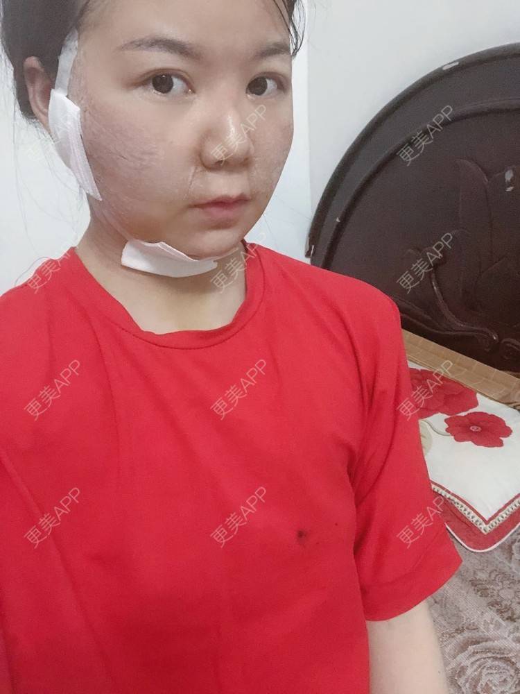 更美 - _对不起，滚远了荣的激光去脂肪粒经验 | 激光去脂肪粒 | 武汉