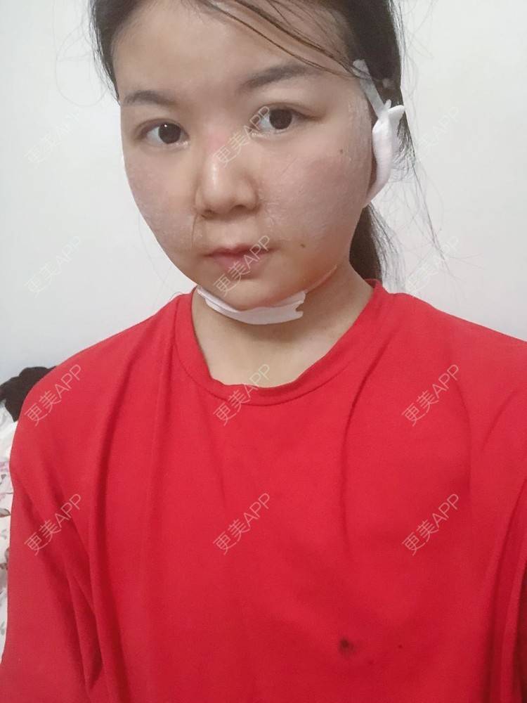 更美 - _对不起，滚远了荣的激光去脂肪粒经验 | 激光去脂肪粒 | 武汉