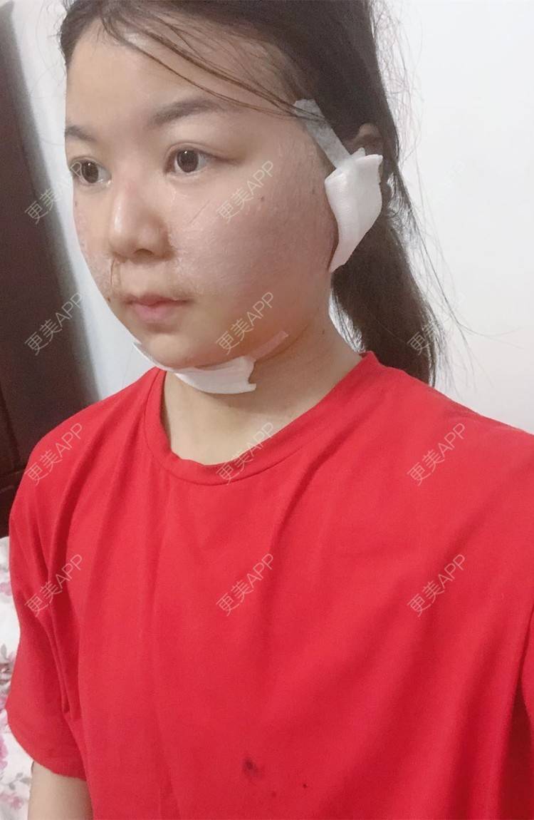 更美 - _对不起，滚远了荣的激光去脂肪粒经验 | 激光去脂肪粒 | 武汉
