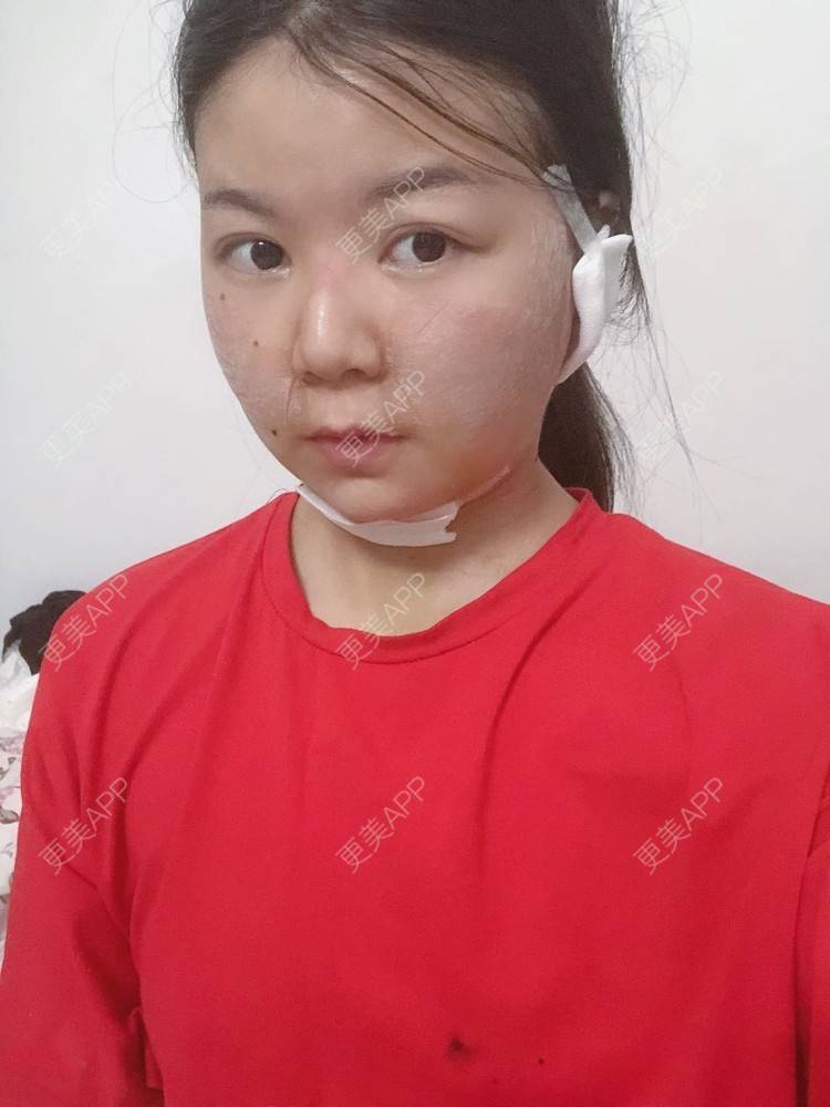 更美 - _对不起，滚远了荣的激光去脂肪粒经验 | 激光去脂肪粒 | 武汉
