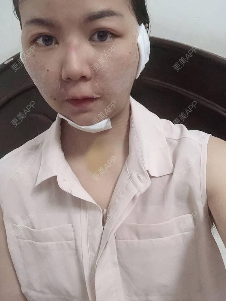 更美 - _对不起，滚远了荣的激光去脂肪粒经验 | 激光去脂肪粒 | 武汉