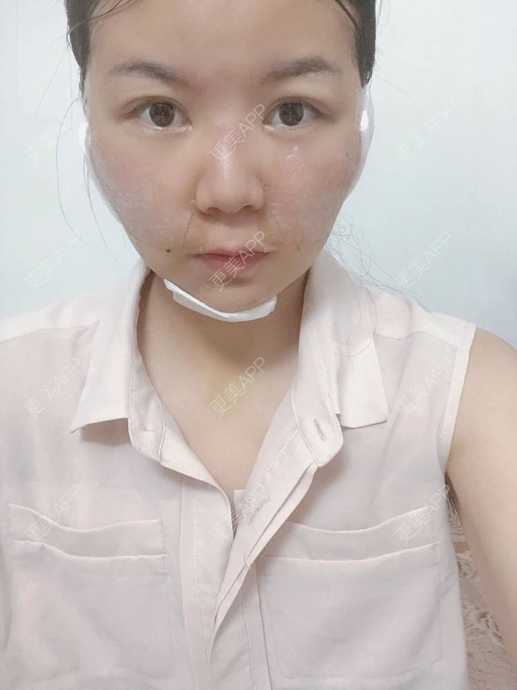 更美 - _对不起，滚远了荣的激光去脂肪粒经验 | 激光去脂肪粒 | 武汉