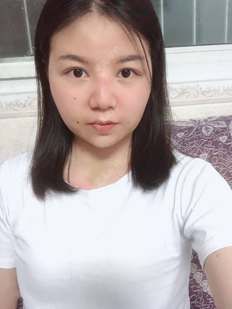 更美 - _对不起，滚远了荣的激光去脂肪粒经验 | 激光去脂肪粒 | 武汉