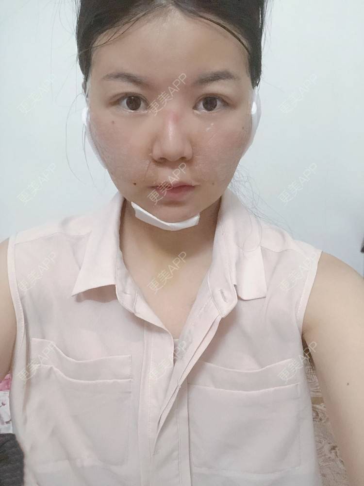 更美 - _对不起，滚远了荣的激光去脂肪粒经验 | 激光去脂肪粒 | 武汉