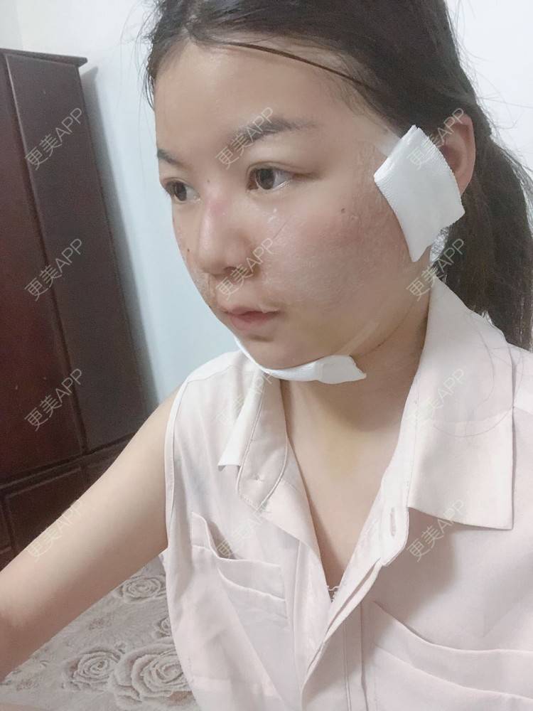更美 - _对不起，滚远了荣的激光去脂肪粒经验 | 激光去脂肪粒 | 武汉