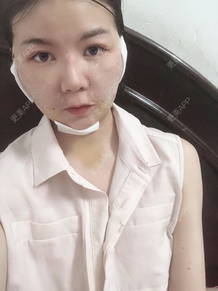 更美 - _对不起，滚远了荣的激光去脂肪粒经验 | 激光去脂肪粒 | 武汉