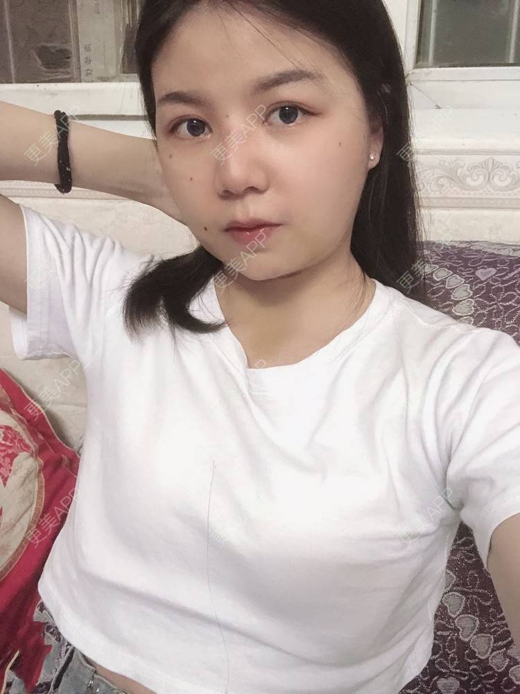 更美 - _对不起，滚远了荣的激光去脂肪粒经验 | 激光去脂肪粒 | 武汉