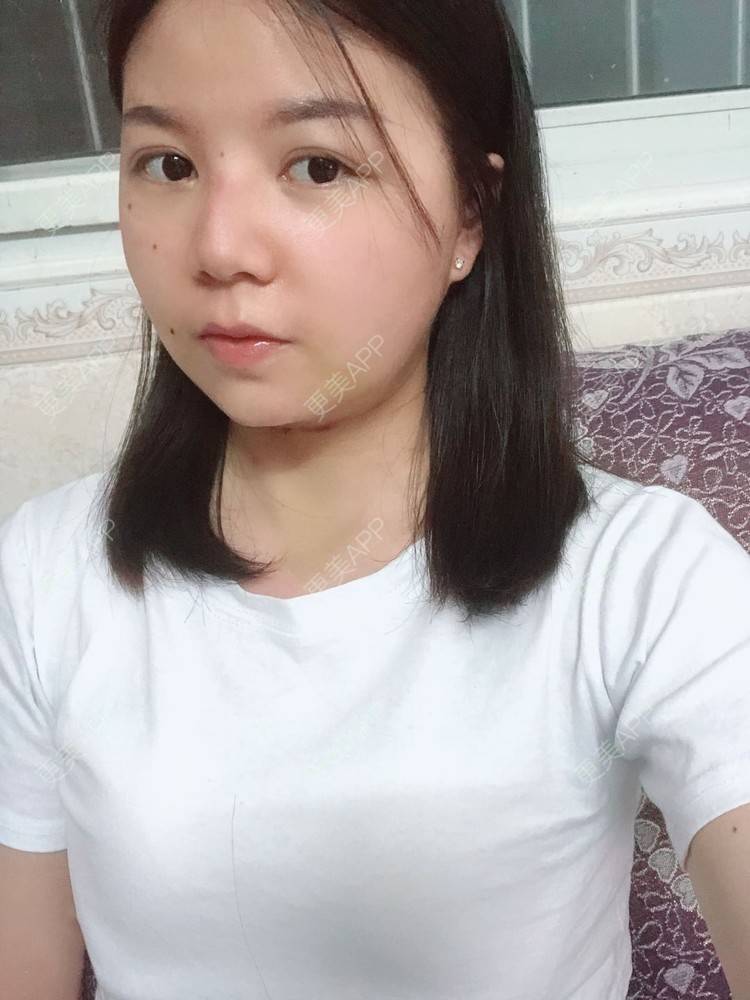更美 - _对不起，滚远了荣的激光去脂肪粒经验 | 激光去脂肪粒 | 武汉