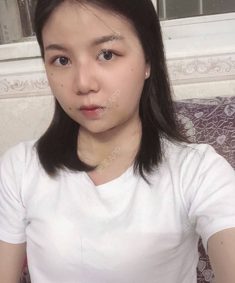 更美 - _对不起，滚远了荣的激光去脂肪粒经验 | 激光去脂肪粒 | 武汉