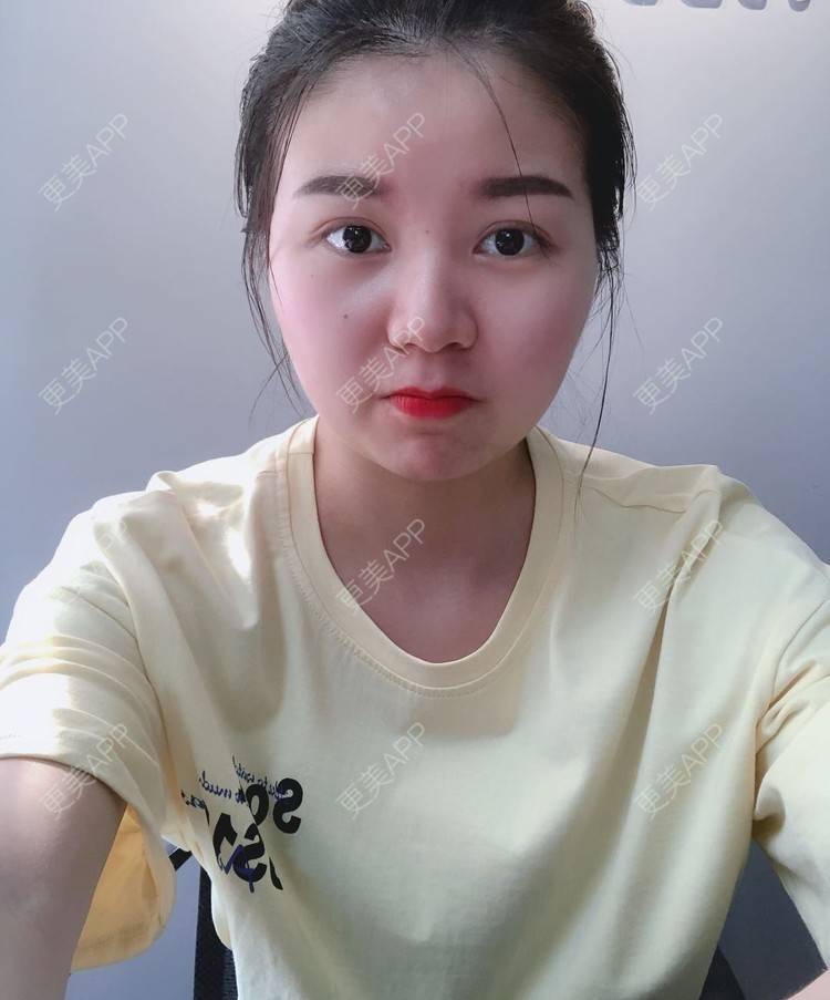 更美 - _对不起，滚远了荣的激光去脂肪粒经验 | 激光去脂肪粒 | 武汉