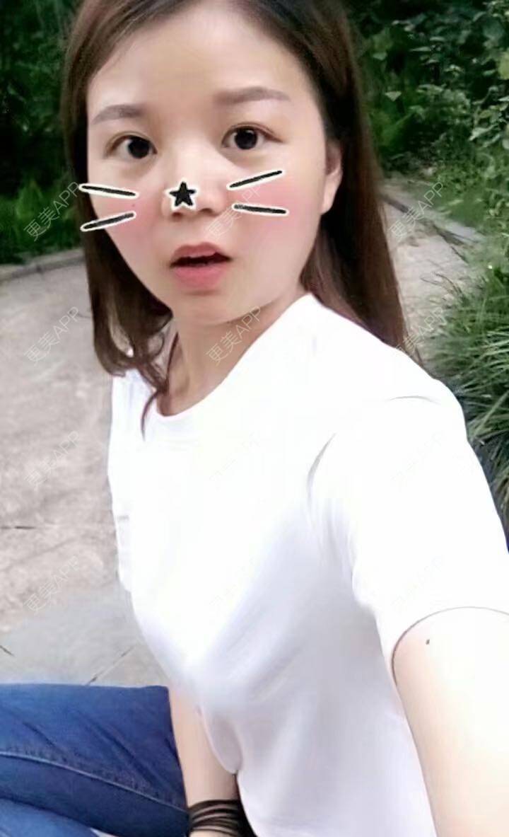 更美 - _对不起，滚远了荣的激光去脂肪粒经验 | 激光去脂肪粒 | 武汉