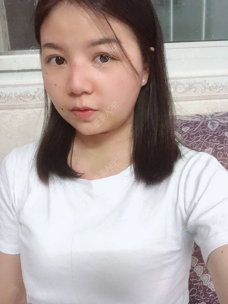 更美 - _对不起，滚远了荣的激光去脂肪粒经验 | 激光去脂肪粒 | 武汉