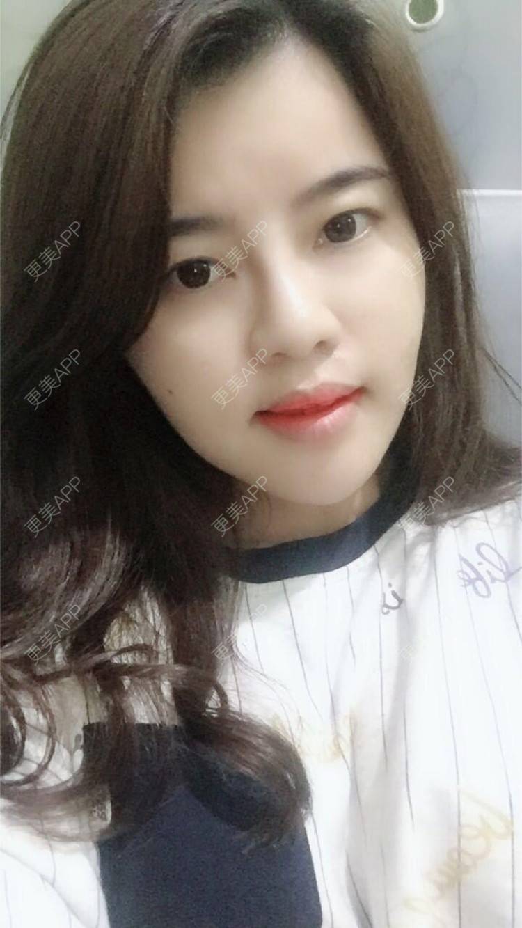 更美 - 郑州缔莱美医疗美容医院的埋线提升经验 | 郑州 | 埋线提升