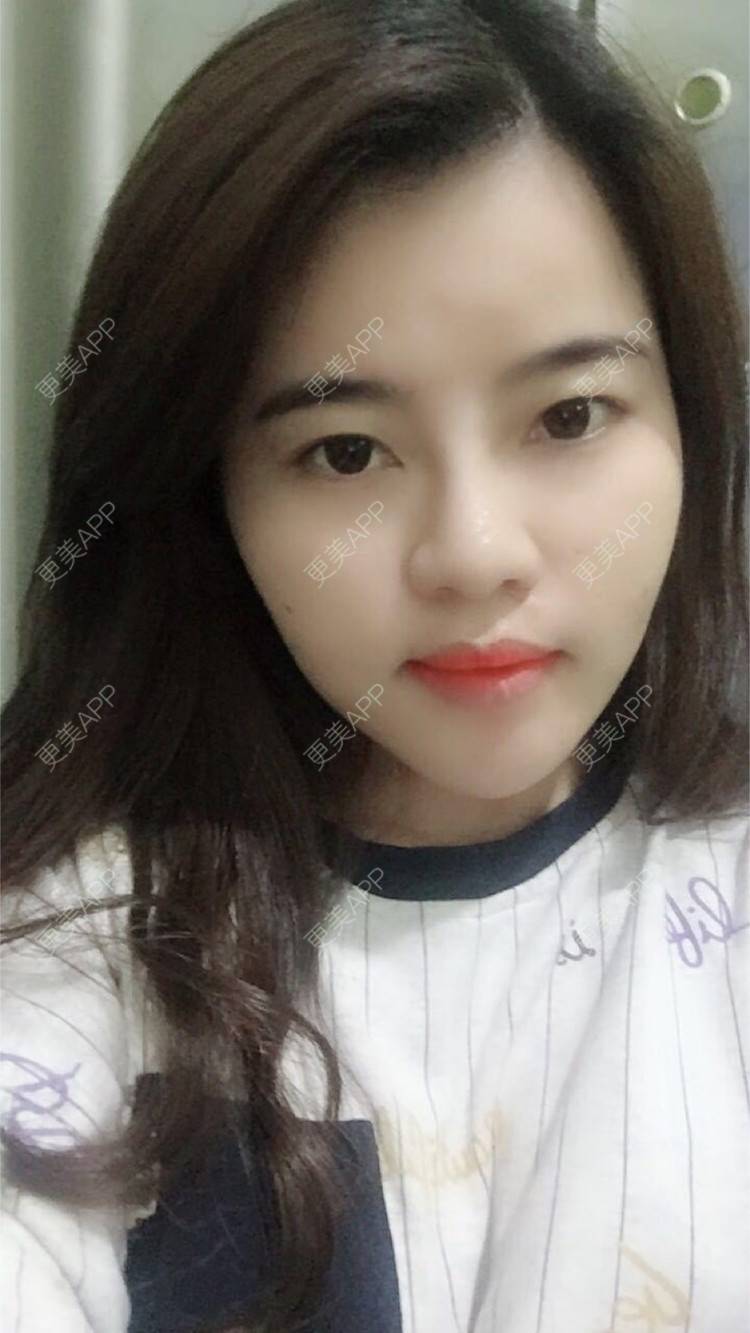 更美 - 郑州缔莱美医疗美容医院的埋线提升经验 | 郑州 | 埋线提升