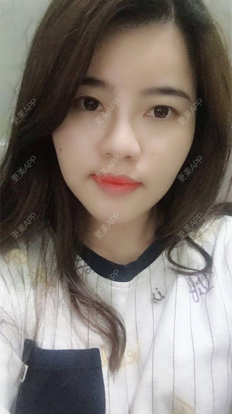 更美 - 郑州缔莱美医疗美容医院的埋线提升经验 | 郑州 | 埋线提升