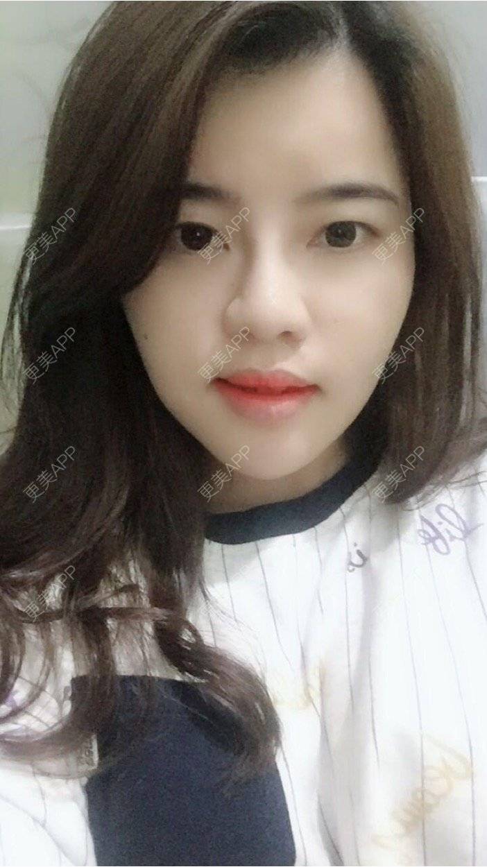 更美 - 郑州缔莱美医疗美容医院的埋线提升经验 | 郑州 | 埋线提升