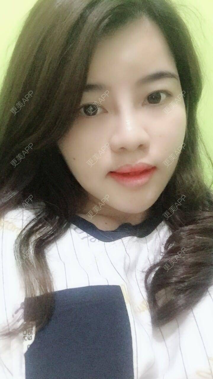 更美 - 郑州缔莱美医疗美容医院的埋线提升经验 | 郑州 | 埋线提升
