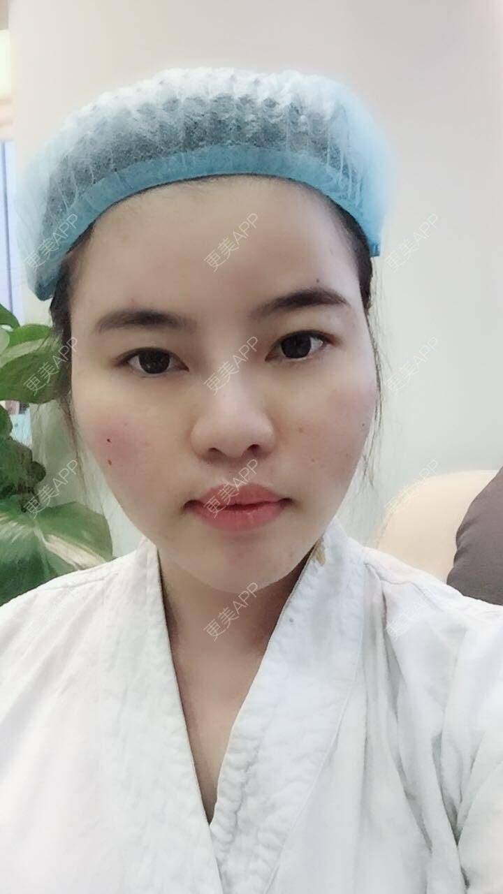 更美 - 郑州缔莱美医疗美容医院的埋线提升经验 | 郑州 | 埋线提升
