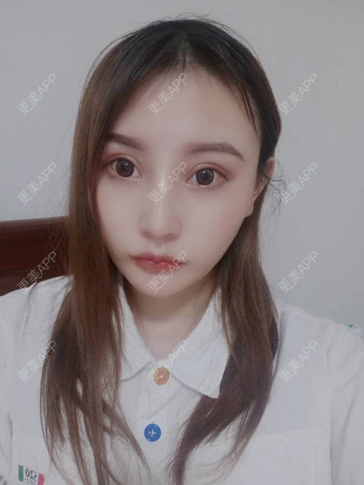 更美 - 更美用户U6Pt7ApV7A的吸脂瘦脸经验 | 吸脂瘦脸 | 重庆