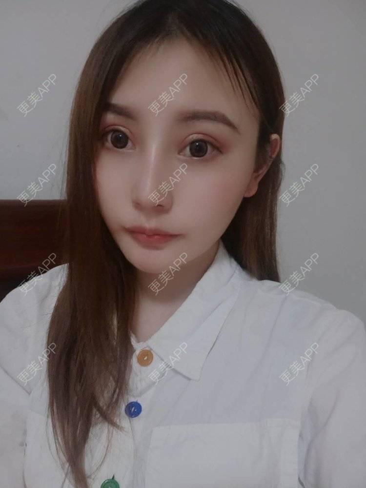 更美 - 更美用户U6Pt7ApV7A的吸脂瘦脸经验 | 吸脂瘦脸 | 重庆