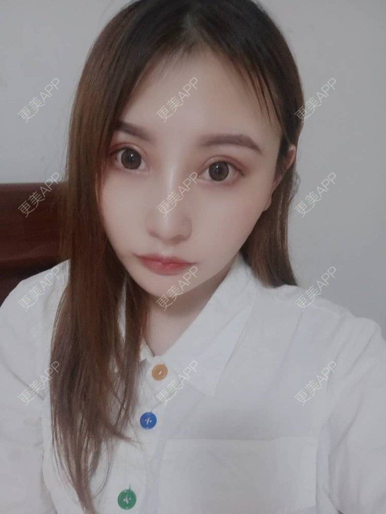 更美 - 更美用户U6Pt7ApV7A的吸脂瘦脸经验 | 吸脂瘦脸 | 重庆