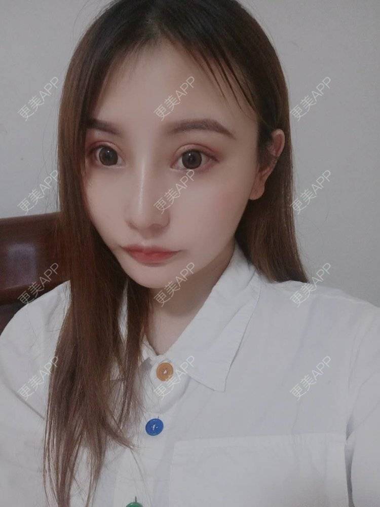 更美 - 更美用户U6Pt7ApV7A的吸脂瘦脸经验 | 吸脂瘦脸 | 重庆