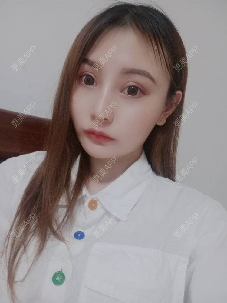 更美 - 更美用户U6Pt7ApV7A的吸脂瘦脸经验 | 吸脂瘦脸 | 重庆