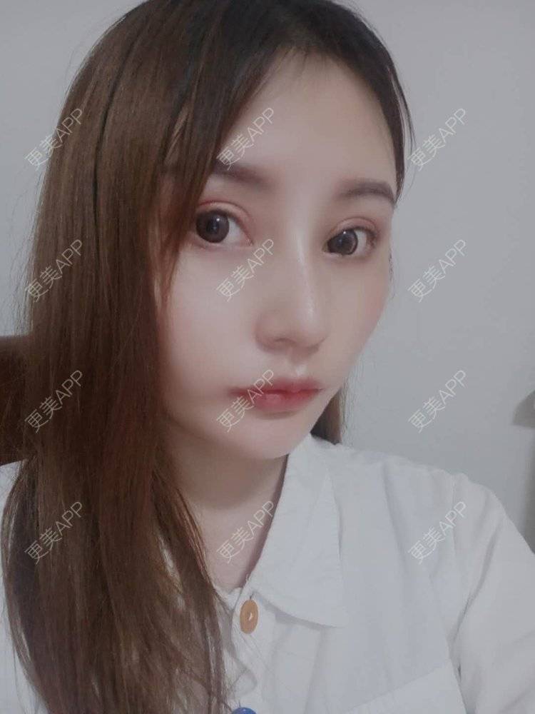 更美 - 更美用户U6Pt7ApV7A的吸脂瘦脸经验 | 吸脂瘦脸 | 重庆