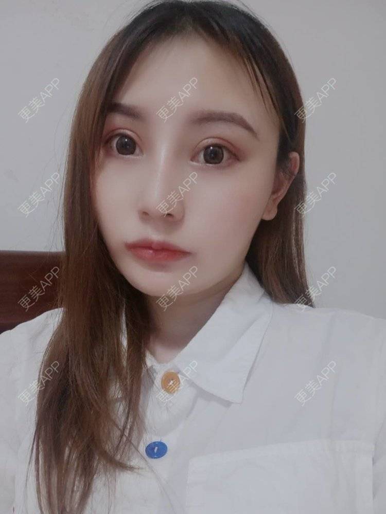 更美 - 更美用户U6Pt7ApV7A的吸脂瘦脸经验 | 吸脂瘦脸 | 重庆