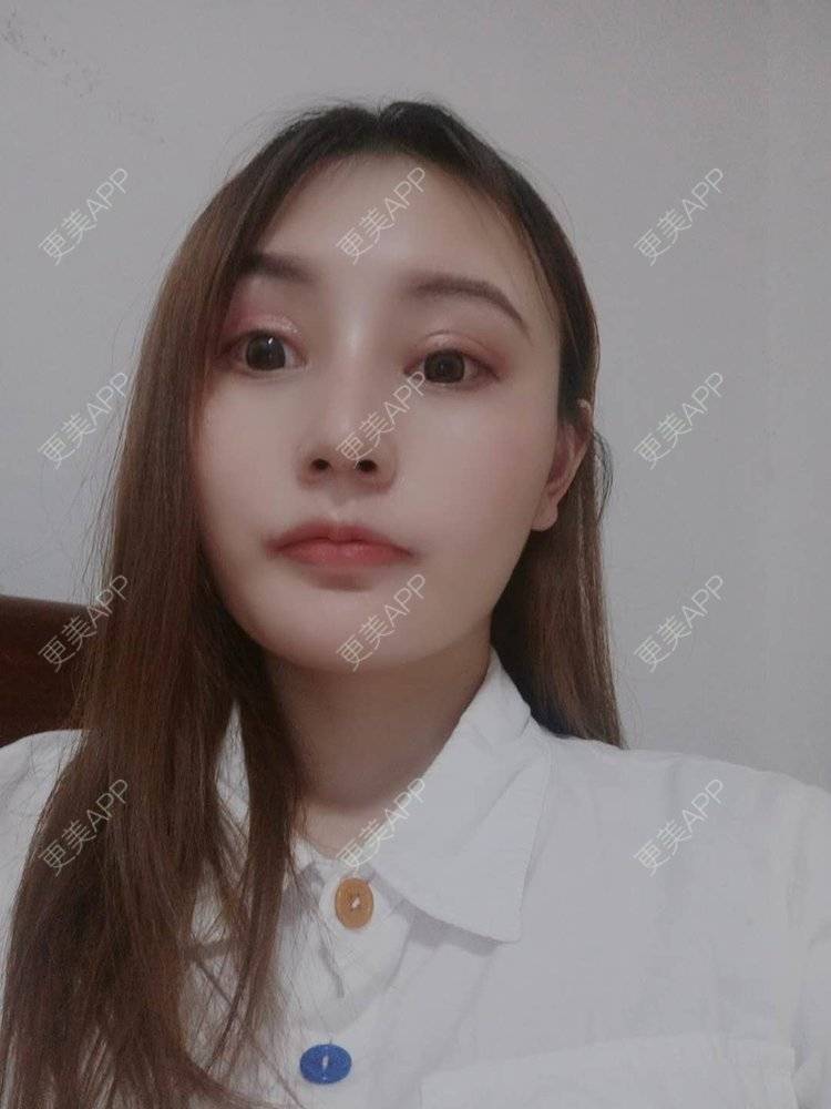 更美 - 更美用户U6Pt7ApV7A的吸脂瘦脸经验 | 吸脂瘦脸 | 重庆