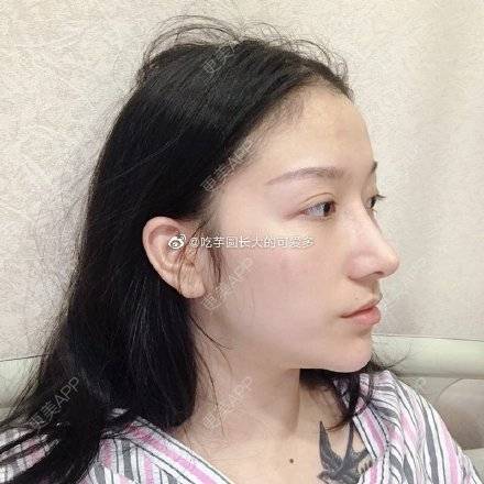 更美 - 爱里承欢一的硅胶垫眉弓经验 | 硅胶垫眉弓 | 武汉