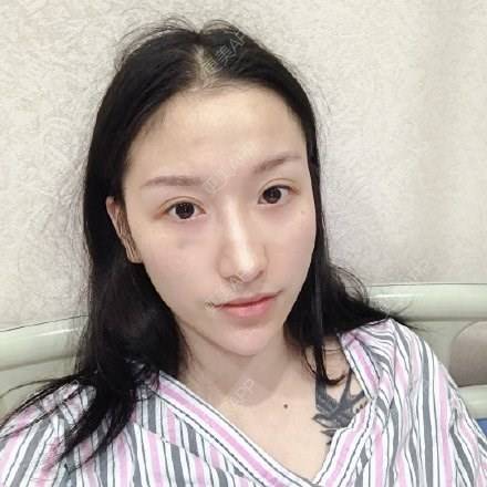 更美 - 爱里承欢一的硅胶垫眉弓经验 | 硅胶垫眉弓 | 武汉