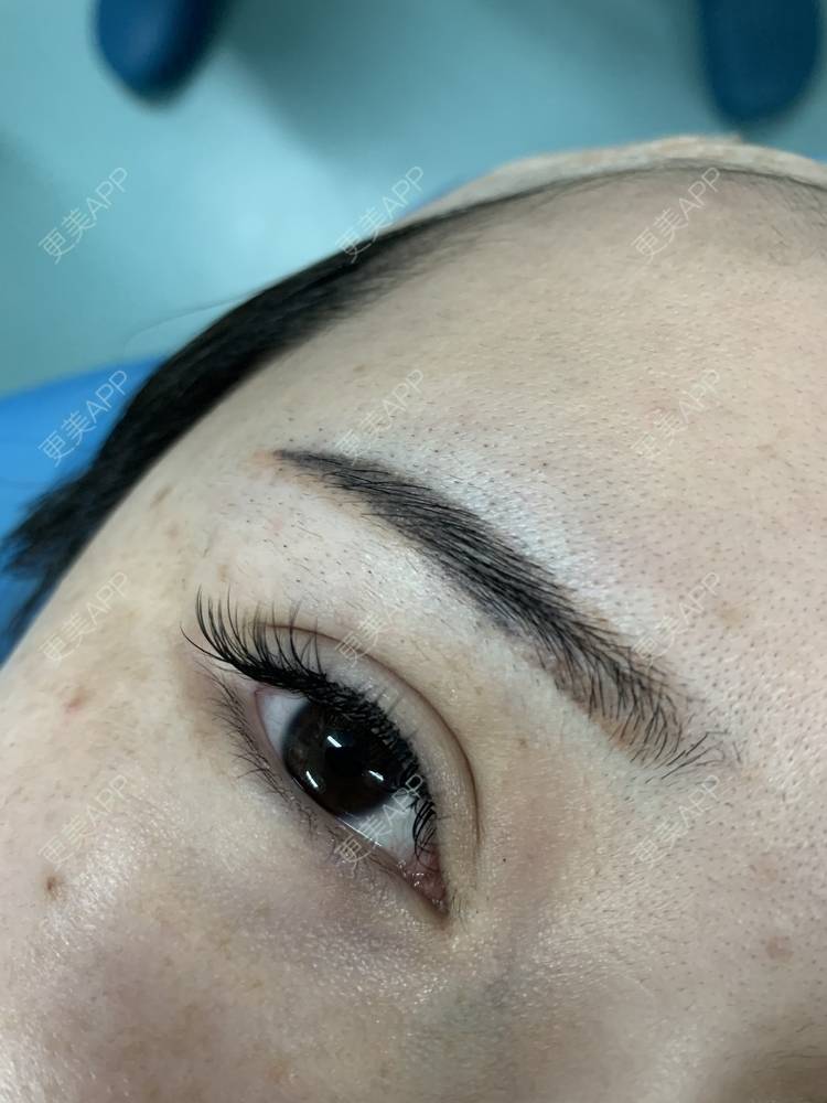 更美 - 更美用户PmjtrkbcVR的额头缩小经验 | 额头缩小 | 上海