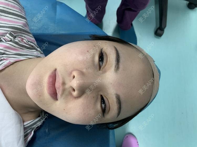 更美 - 更美用户PmjtrkbcVR的额头缩小经验 | 额头缩小 | 上海