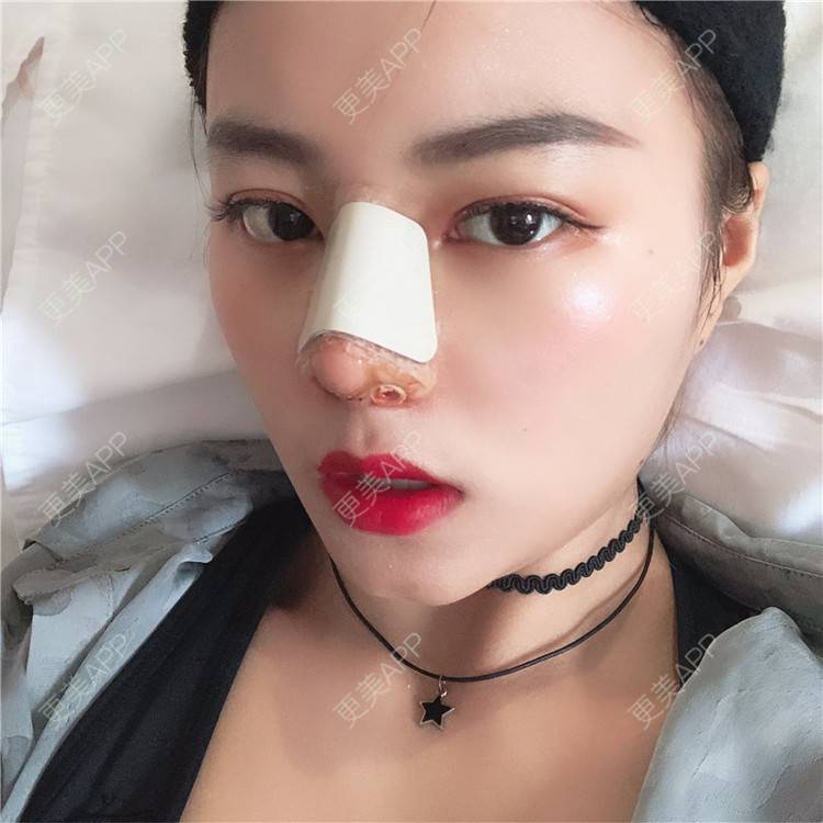 更美 - 更美用户lTbbyKeLJ6的隆鼻经验 | 杭州 | 隆鼻