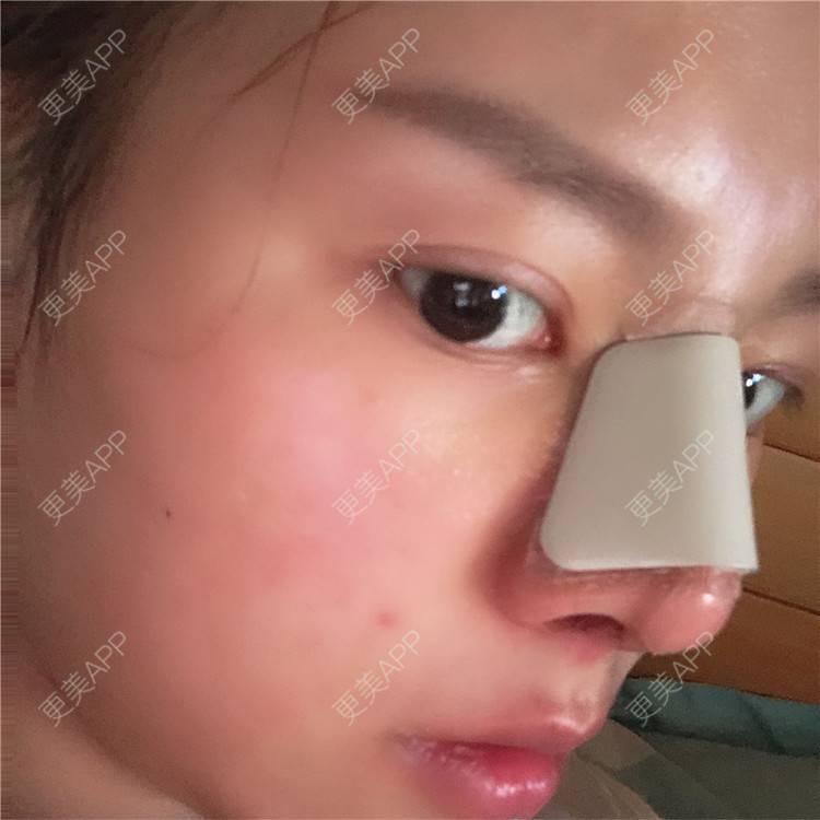 更美 - 更美用户lTbbyKeLJ6的隆鼻经验 | 杭州 | 隆鼻