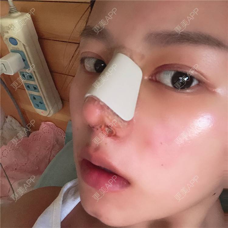更美 - 更美用户lTbbyKeLJ6的隆鼻经验 | 杭州 | 隆鼻