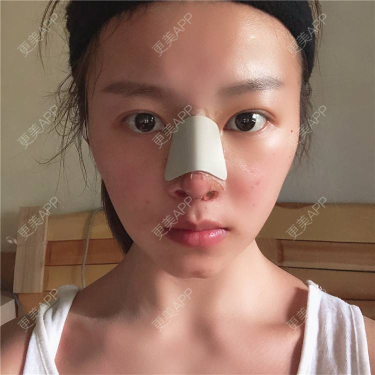 更美 - 更美用户lTbbyKeLJ6的隆鼻经验 | 杭州 | 隆鼻