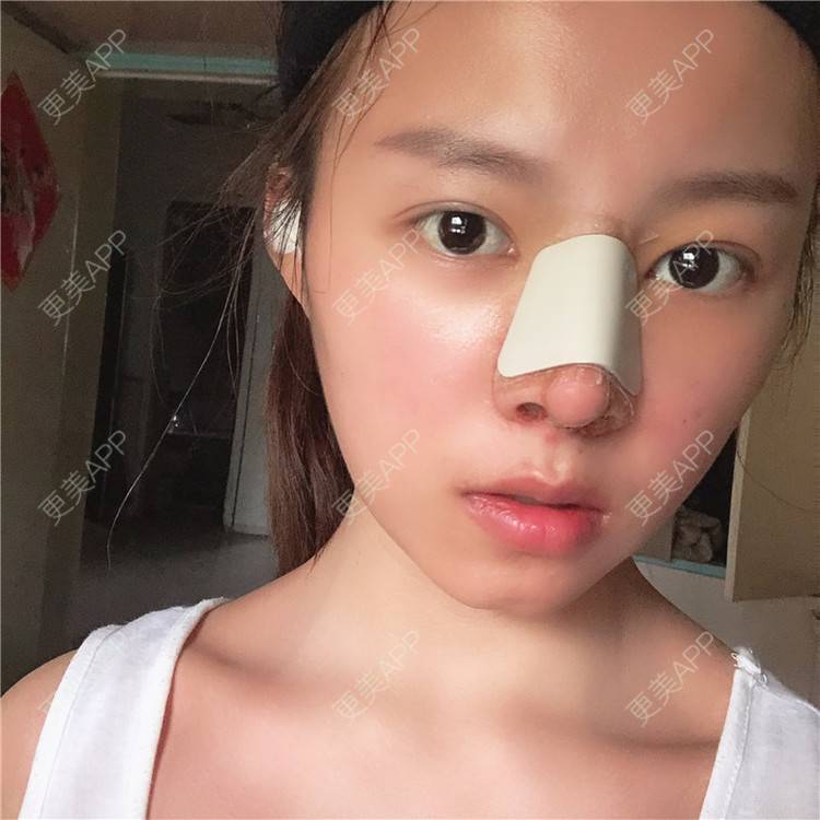 更美 - 更美用户lTbbyKeLJ6的隆鼻经验 | 杭州 | 隆鼻
