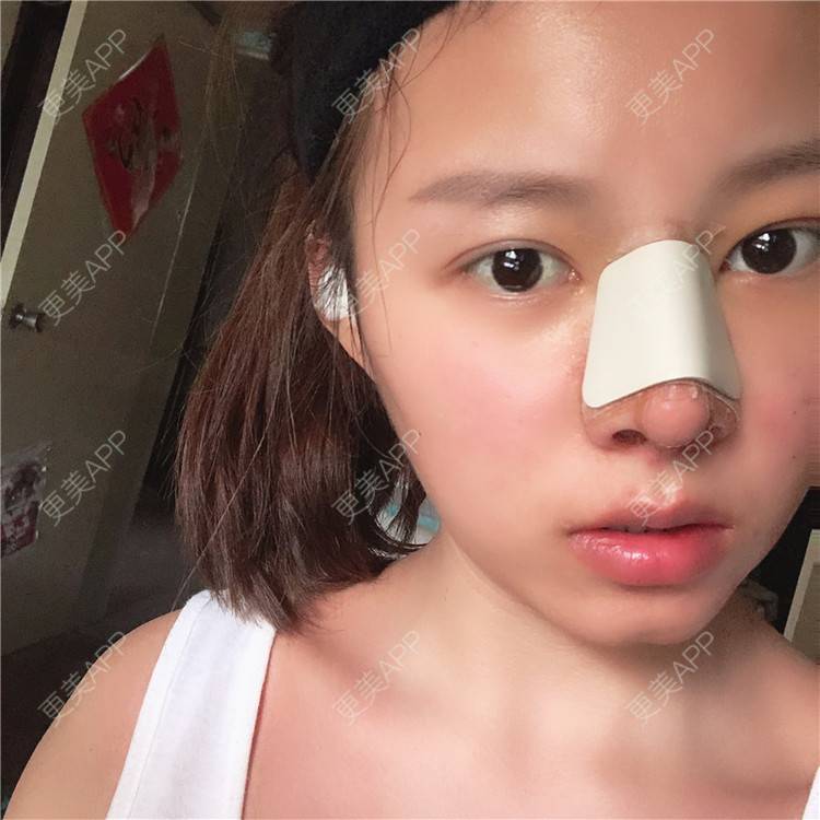 更美 - 更美用户lTbbyKeLJ6的隆鼻经验 | 杭州 | 隆鼻