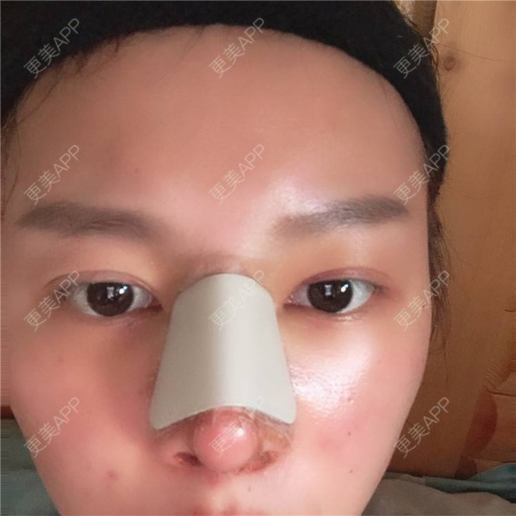 更美 - 更美用户lTbbyKeLJ6的隆鼻经验 | 杭州 | 隆鼻