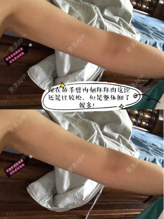 更美 - 叁小妹的背部吸脂经验 | 手臂吸脂 | 背部吸脂 | 成都