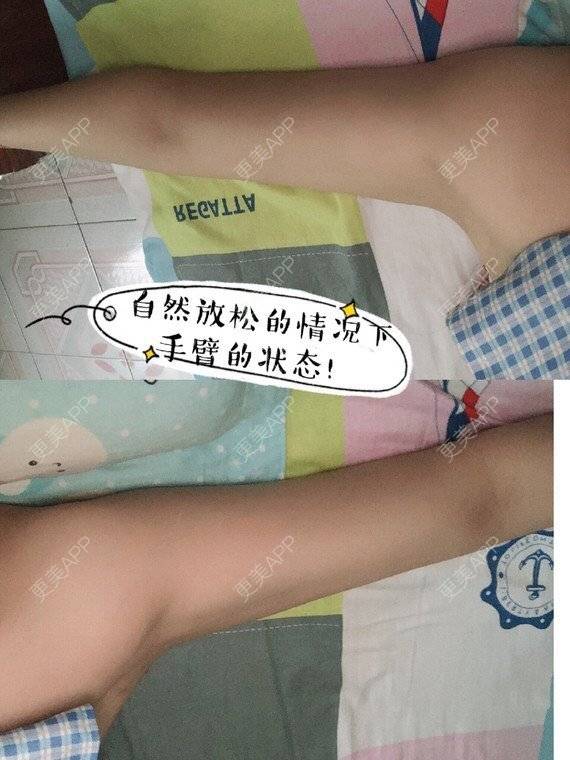 更美 - 叁小妹的背部吸脂经验 | 手臂吸脂 | 背部吸脂 | 成都